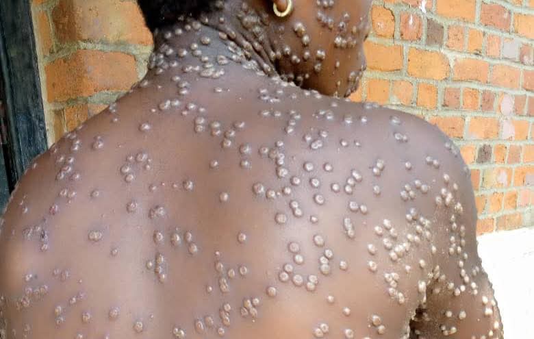 Commune de Matoto: Alerte des populations sur l’épidémie Mpox ou variole du singe
